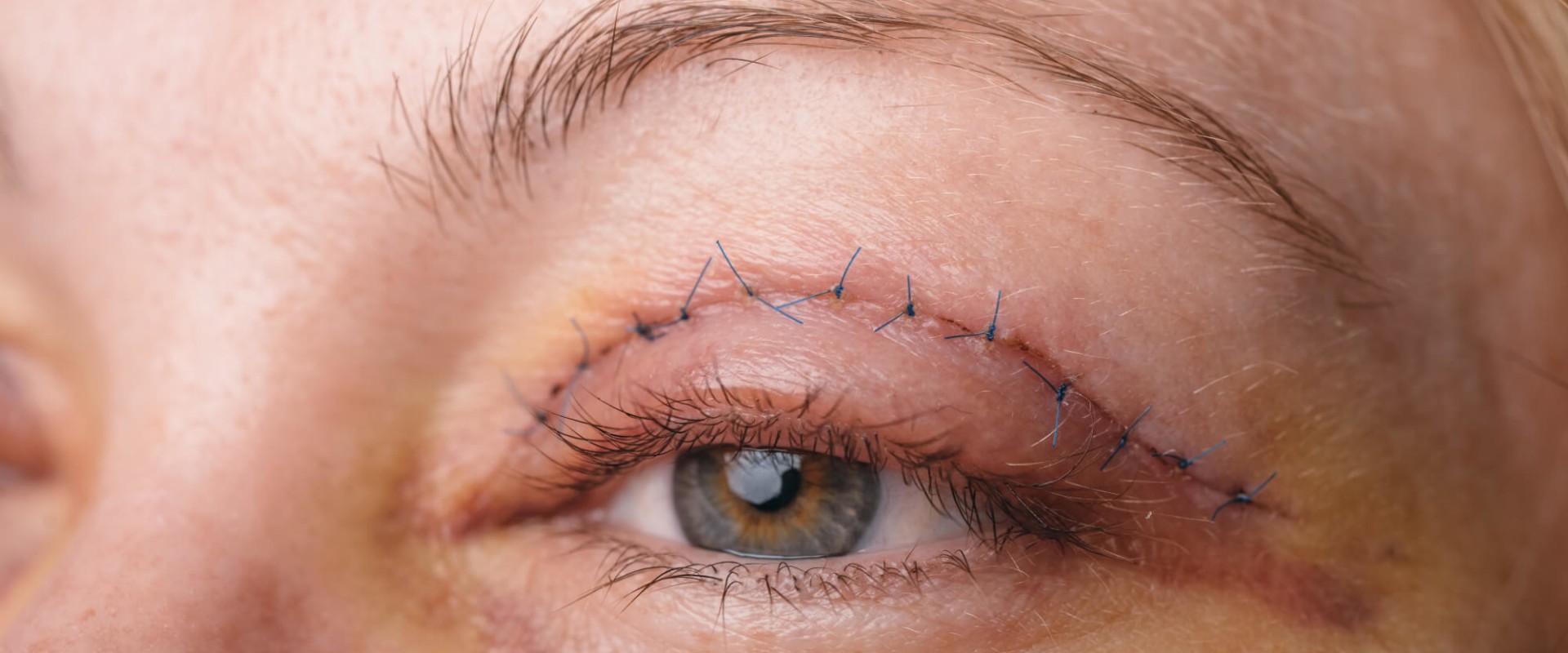 Understanding Eyelid Surgery: Everything You Need to Know