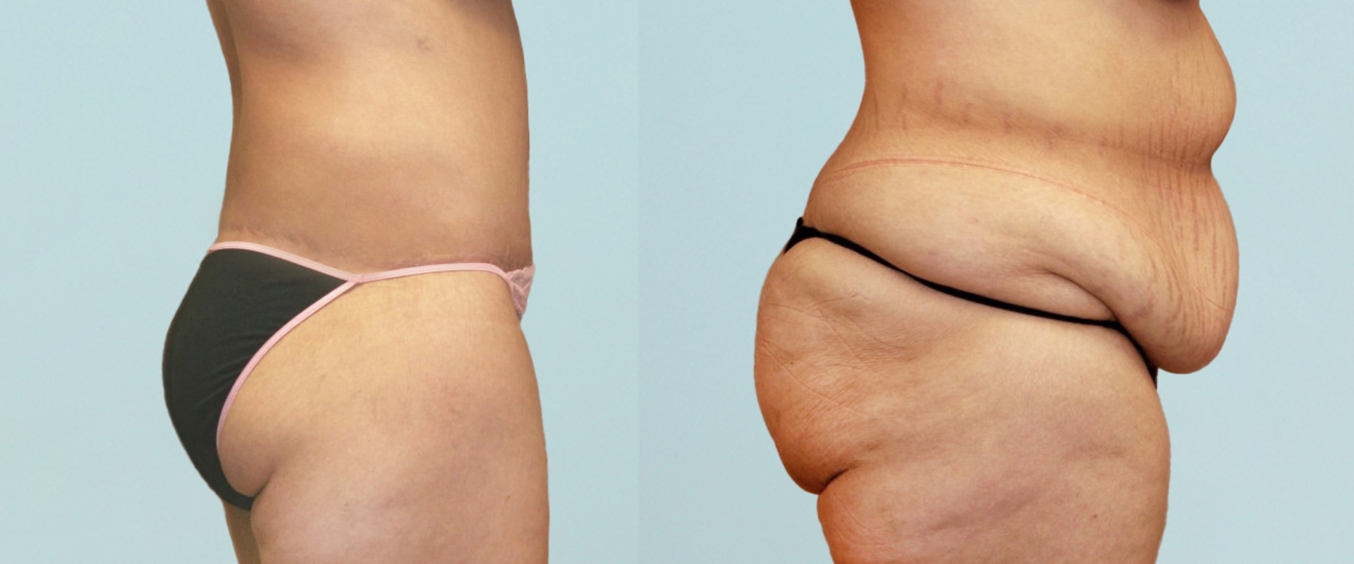 Understanding Body Shape and Proportions: A Comprehensive Look at Plastic Surgery for Women