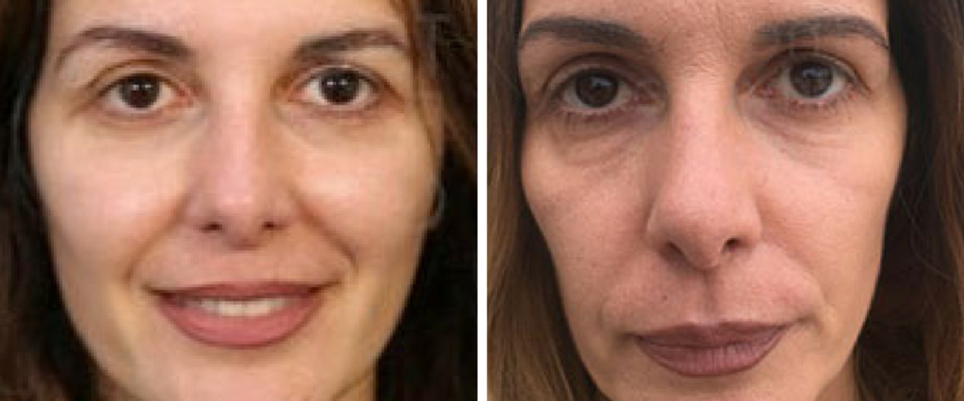 Facelift: Understanding Plastic Surgery Procedures and Options for Men and Women