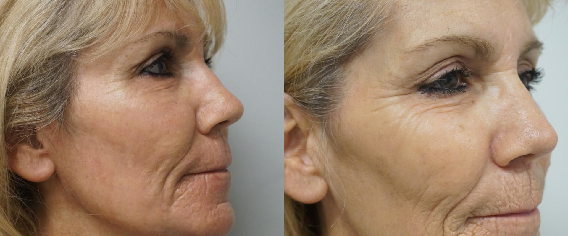 The Ins and Outs of Laser Skin Resurfacing