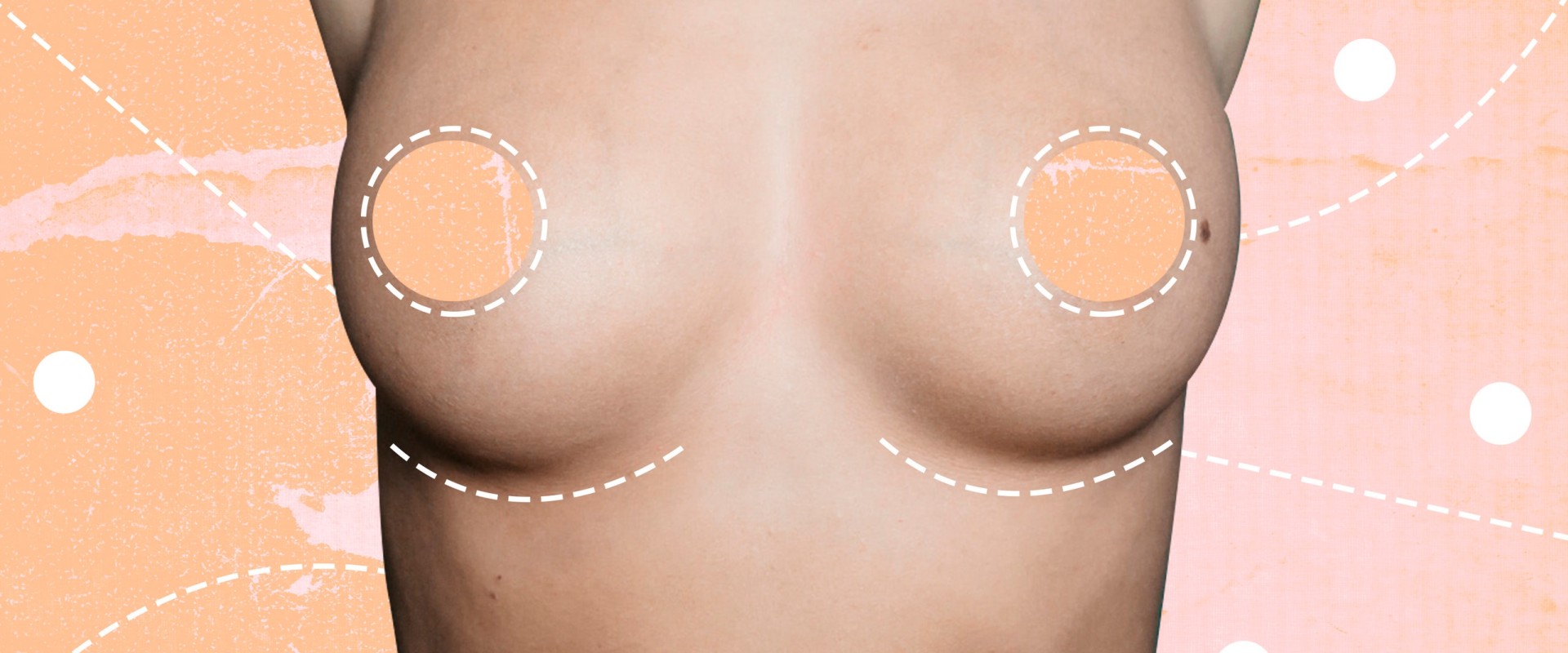 The Ins and Outs of Breast Augmentation