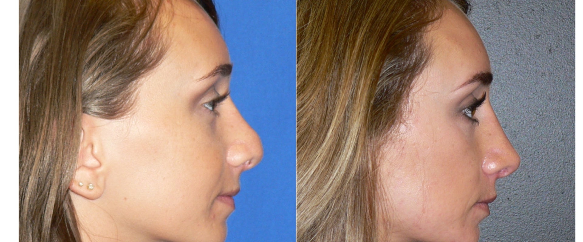 What plastic surgery has the hardest recovery?