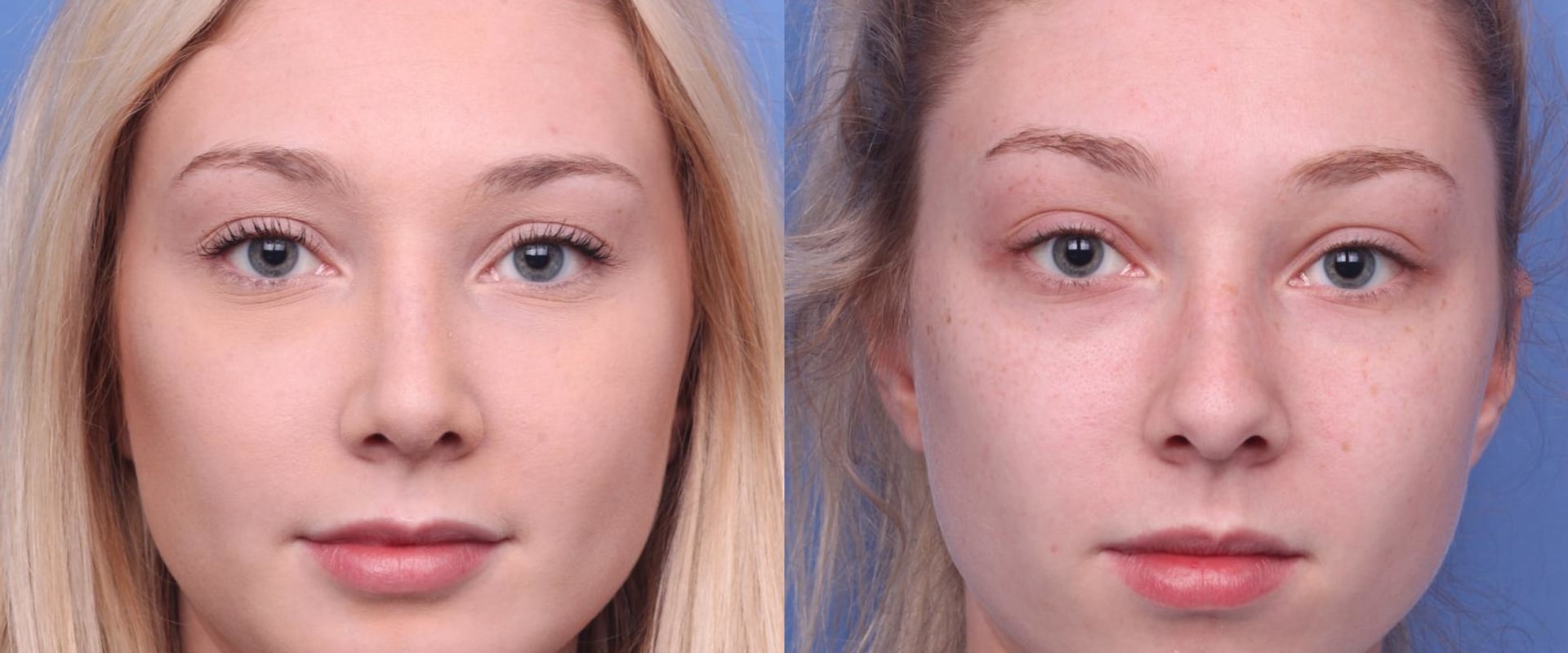 How do people feel after plastic surgery?