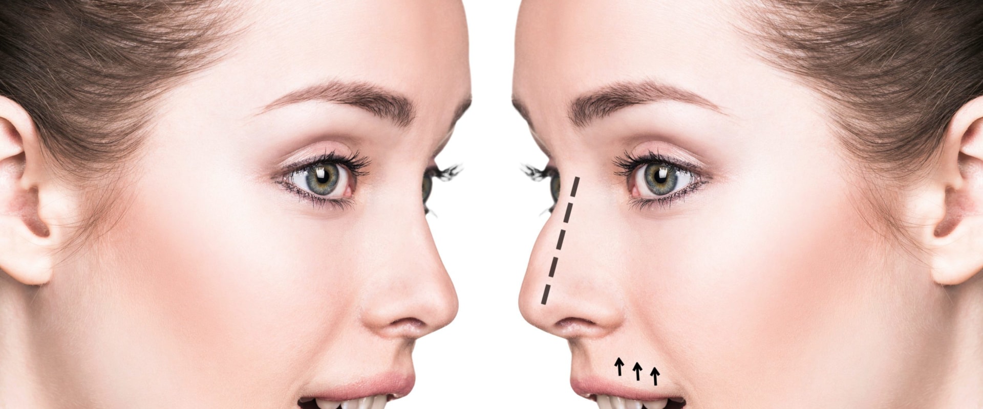 Covering All About Rhinoplasty: What You Need to Know