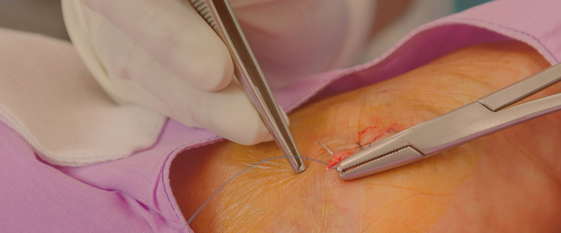 Wound Care: Everything You Need to Know About Plastic Surgery Recovery