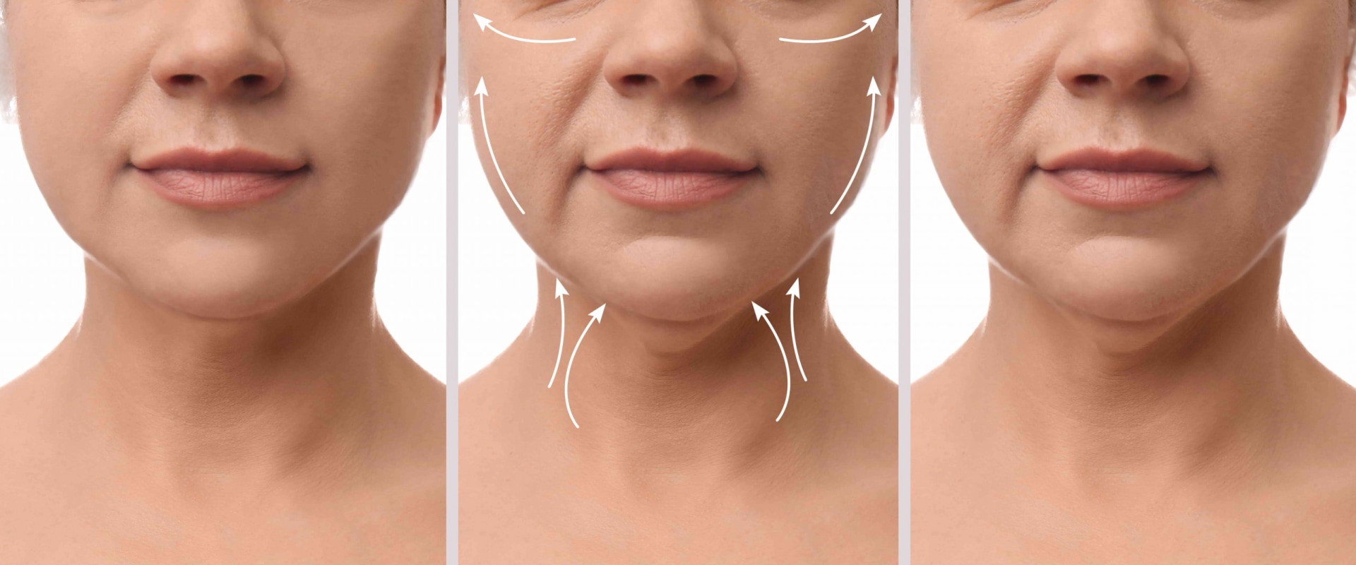 Understanding Neck Lift: Everything You Need to Know