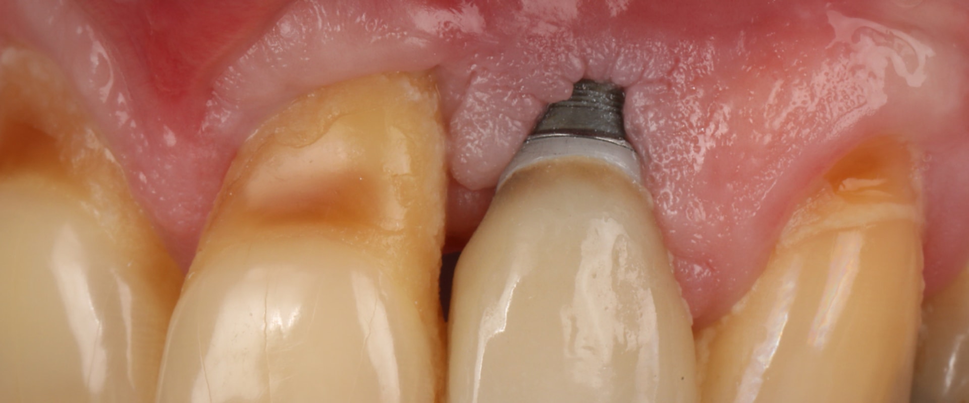 Understanding Implant Complications: What You Need to Know