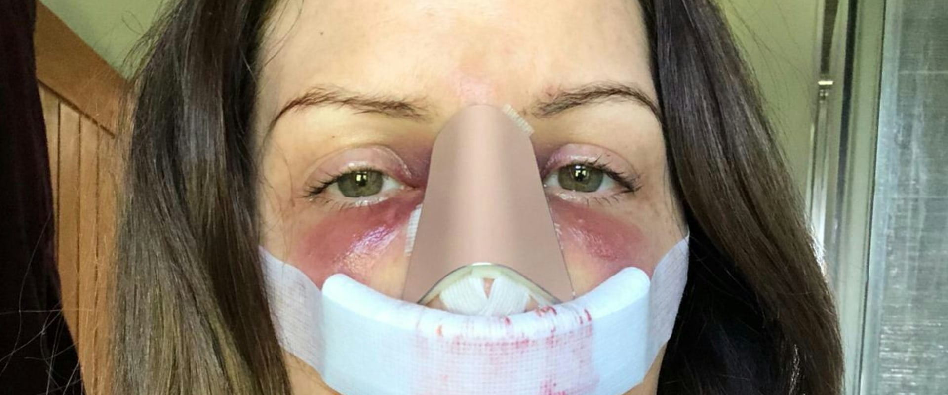 A Comprehensive Look at Plastic Surgery Recovery in the First Week