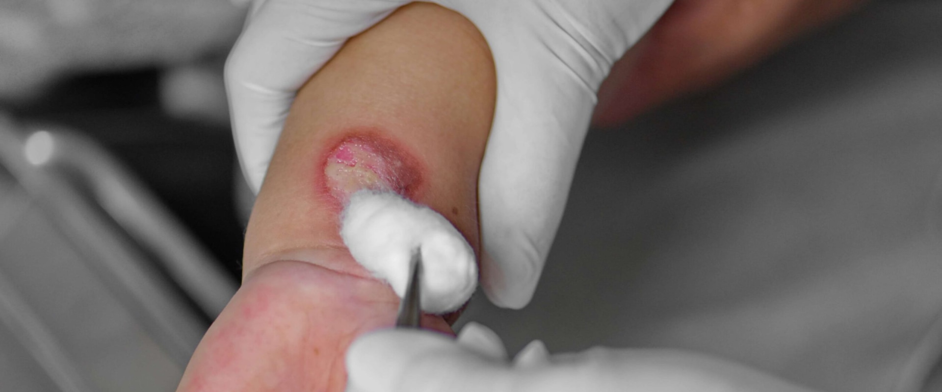 Understanding Burn Injury Repair: Everything You Need to Know