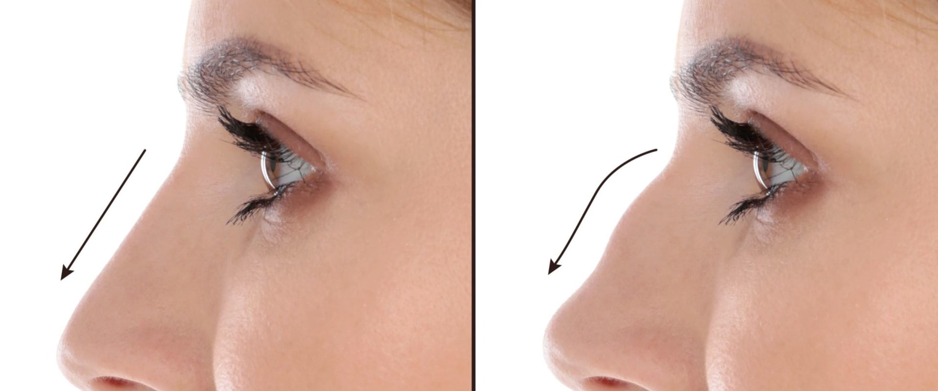 Understanding Rhinoplasty: What You Need to Know