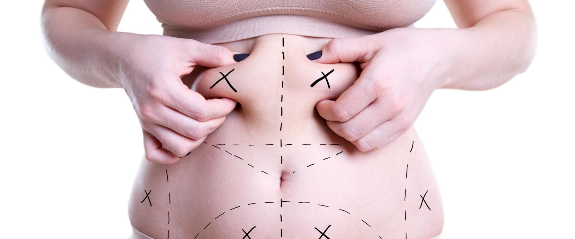 Understanding Liposuction: Everything You Need to Know