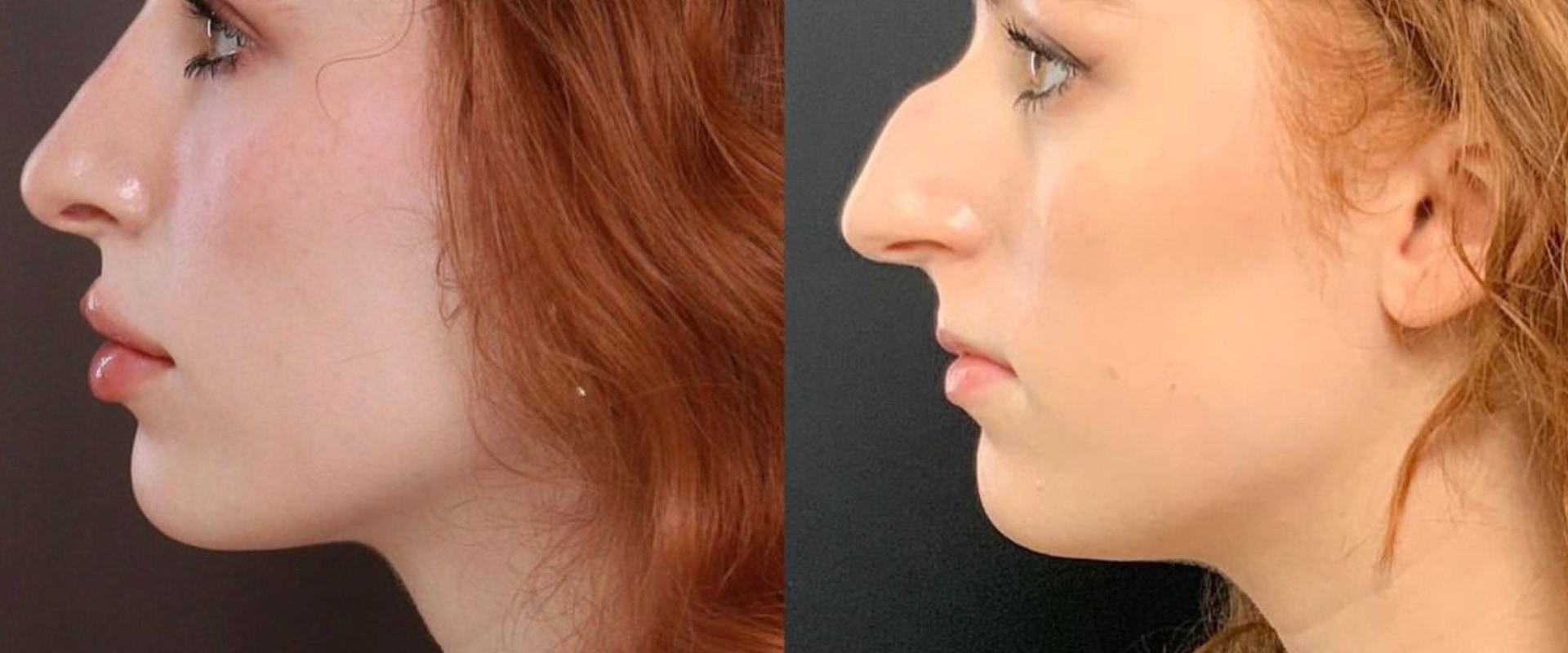 Do people feel more confident after plastic surgery?