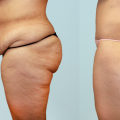 Understanding Body Shape and Proportions: A Comprehensive Look at Plastic Surgery for Women