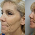 The Ins and Outs of Laser Skin Resurfacing