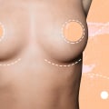 The Ins and Outs of Breast Augmentation