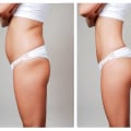 All You Need to Know about Liposuction