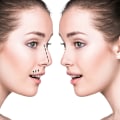 Covering All About Rhinoplasty: What You Need to Know