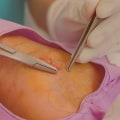 Wound Care: Everything You Need to Know About Plastic Surgery Recovery