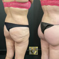 All You Need to Know About Buttock Lift Surgery