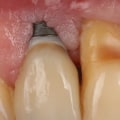 Understanding Implant Complications: What You Need to Know