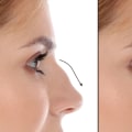 Understanding Rhinoplasty: What You Need to Know