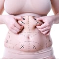 Understanding Liposuction: Everything You Need to Know