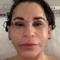 Understanding Swelling After Plastic Surgery