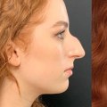 Do people feel more confident after plastic surgery?