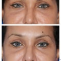 Understanding Brow Lift Surgery