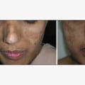 Understanding Scarring: A Comprehensive Guide to Plastic Surgery Risks