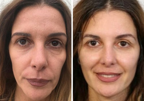 Facelift: Understanding Plastic Surgery Procedures and Options for Men and Women