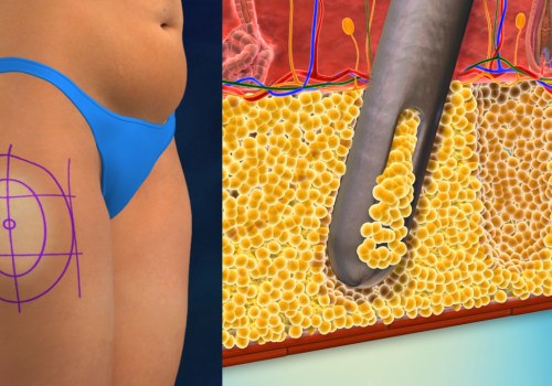 Understanding Liposuction: Costs, Risks, and Recovery Process