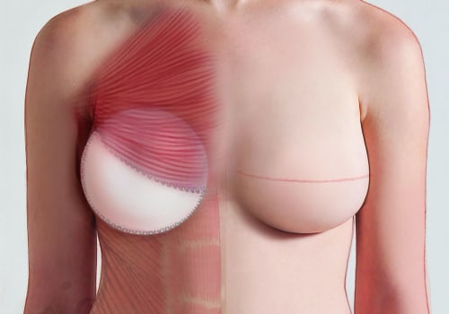 Covering All About Breast Reconstruction