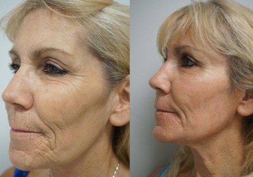 The Ins and Outs of Laser Skin Resurfacing