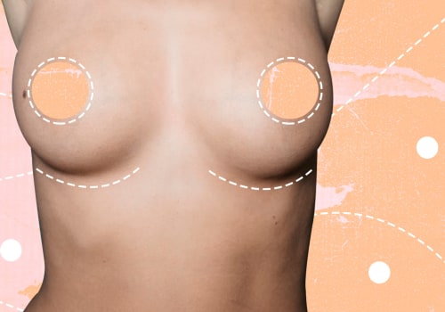 The Ins and Outs of Breast Augmentation