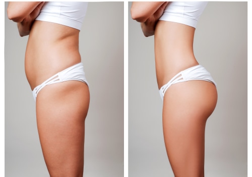 All You Need to Know about Liposuction