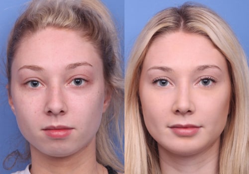 How do people feel after plastic surgery?