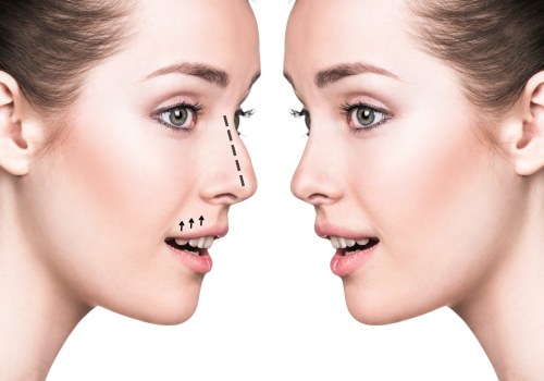 Covering All About Rhinoplasty: What You Need to Know