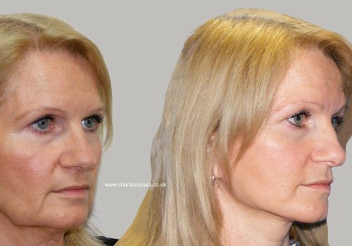 What is the most difficult facial plastic surgery?