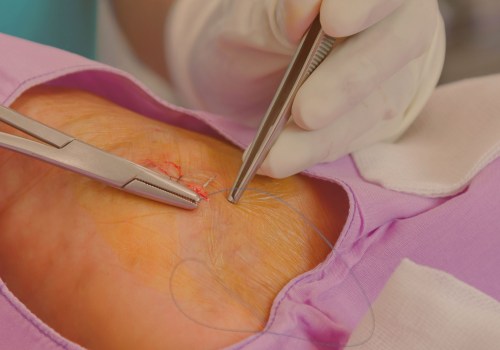 Wound Care: Everything You Need to Know About Plastic Surgery Recovery