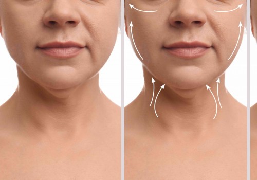 Understanding Neck Lift: Everything You Need to Know