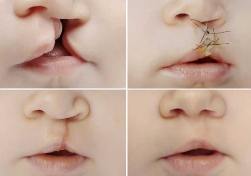 Understanding Cleft Palate Repair: Everything You Need to Know