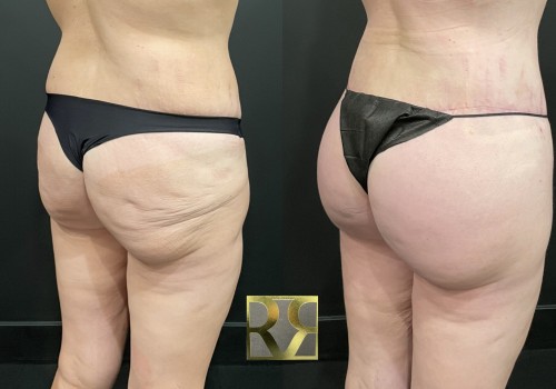 All You Need to Know About Buttock Lift Surgery