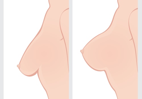 The Ultimate Guide to Breast Lift: Everything You Need to Know