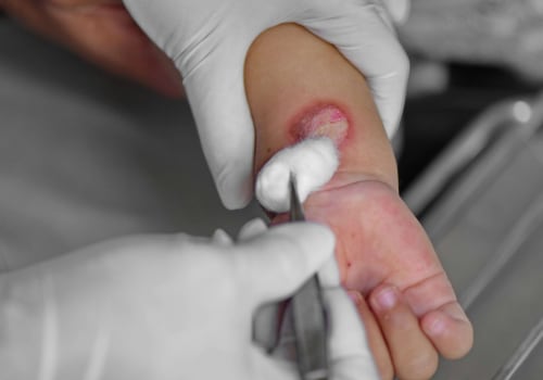 Understanding Burn Injury Repair: Everything You Need to Know