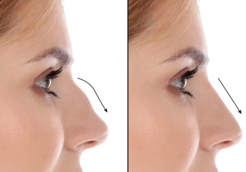 Understanding Rhinoplasty: What You Need to Know