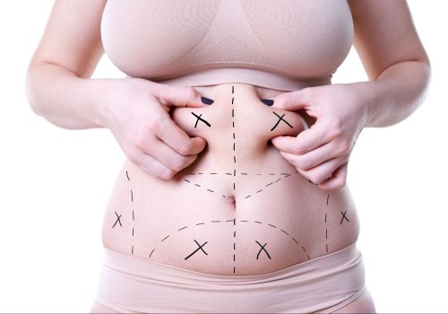 Understanding Liposuction: Everything You Need to Know