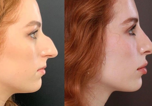 Do people feel more confident after plastic surgery?