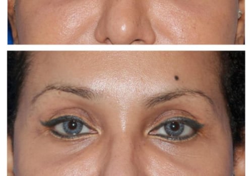 Understanding Brow Lift Surgery